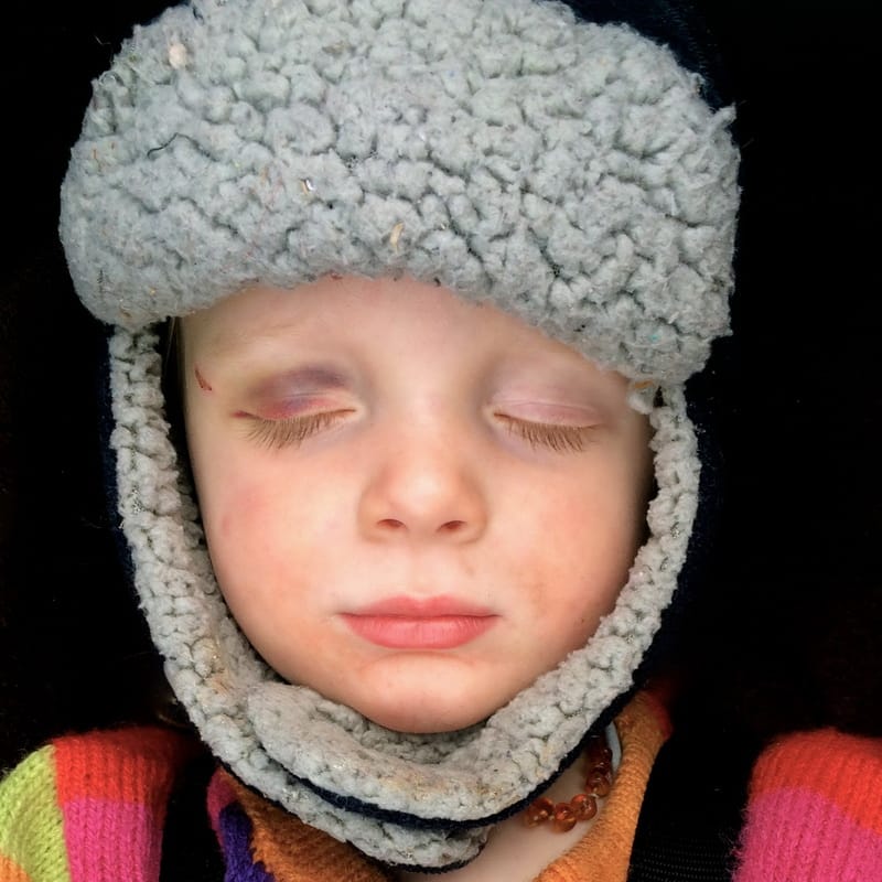 First black eye